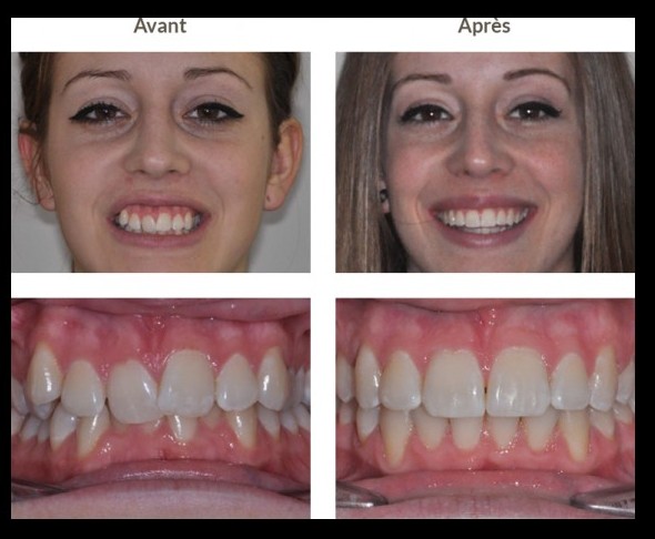 Avant/Après Orthodontie